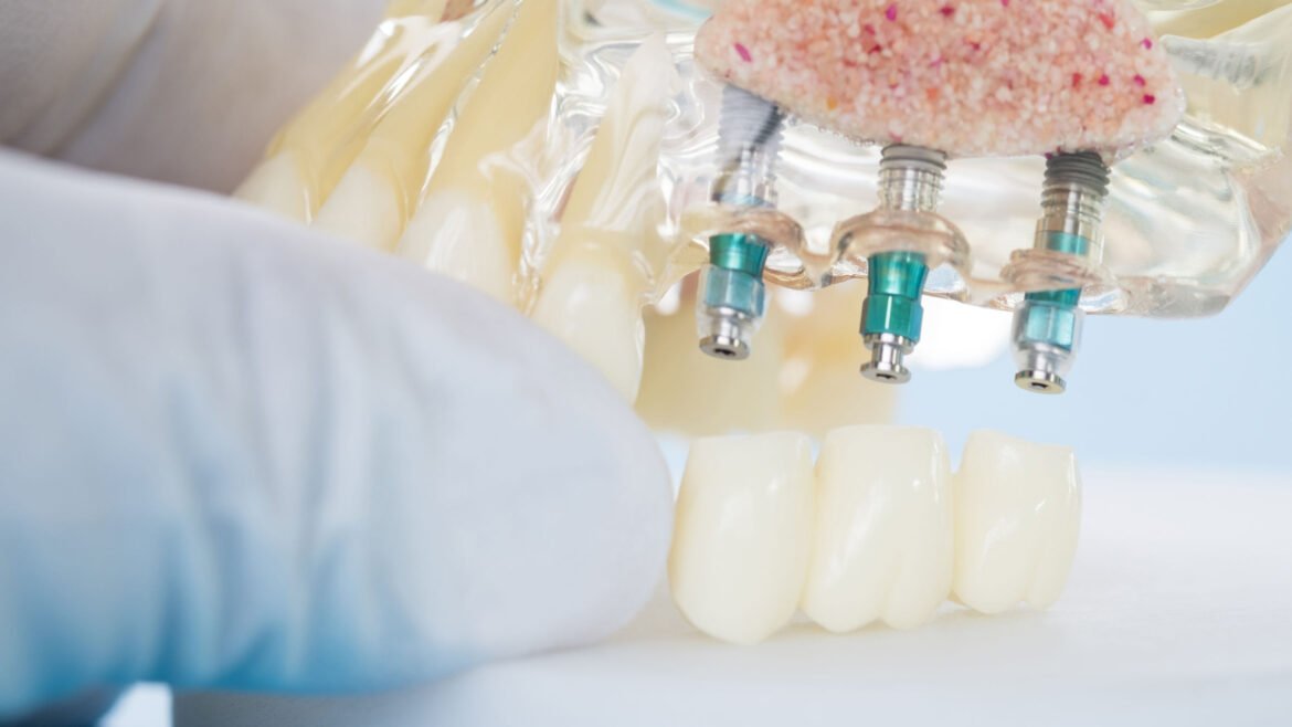 Dantų implantai ir protezavimas