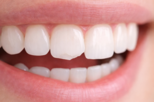 Priekinio danties nuskilimas – situacija, kai svarbu greitai apsaugoti dantį ir kreiptis į odontologą.