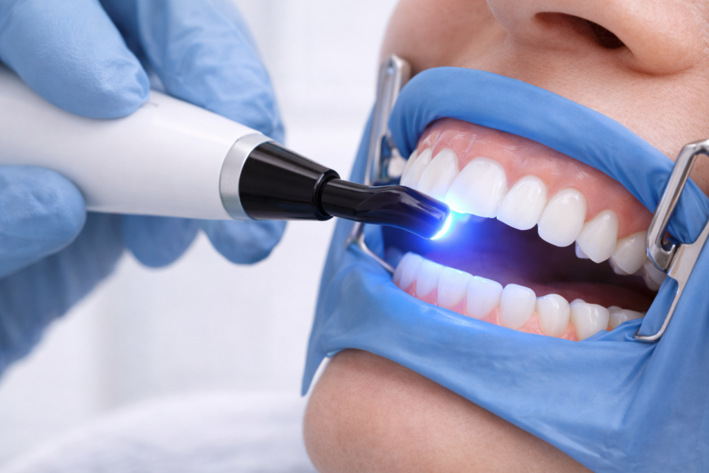 Priekinio danties atstatymas kompozitu – greitas estetikos atkūrimas klinikoje.